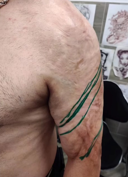 Narben abdecken mit Tattoo in Berlin – Brandnarben, OP-Narben und Schwangerschaftsstreifen bei Tiba Tattoo