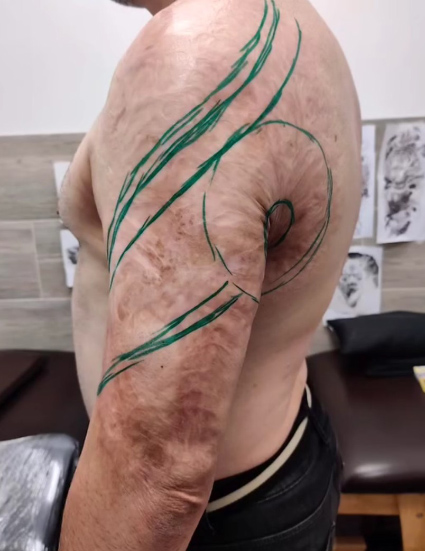 Kaiserschnittnarbe und Brandnarben Cover-Up in Berlin – Ergebnisse aus dem Tiba Tattoo Studio